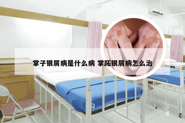 掌子银屑病是什么病 掌跖银屑病怎么治