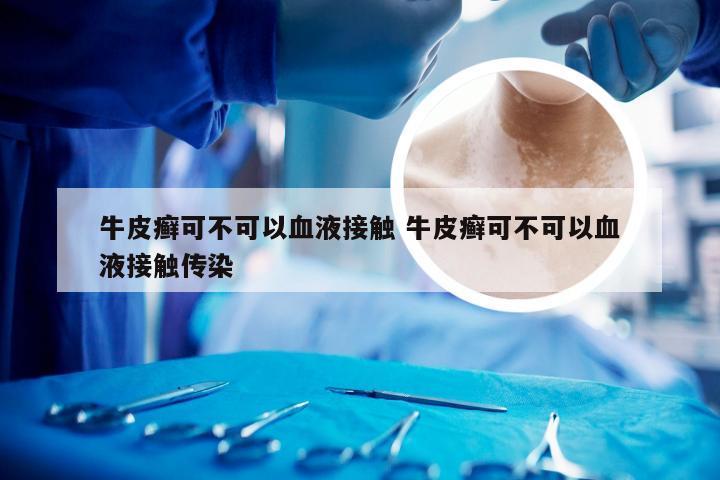 牛皮癣可不可以血液接触 牛皮癣可不可以血液接触传染