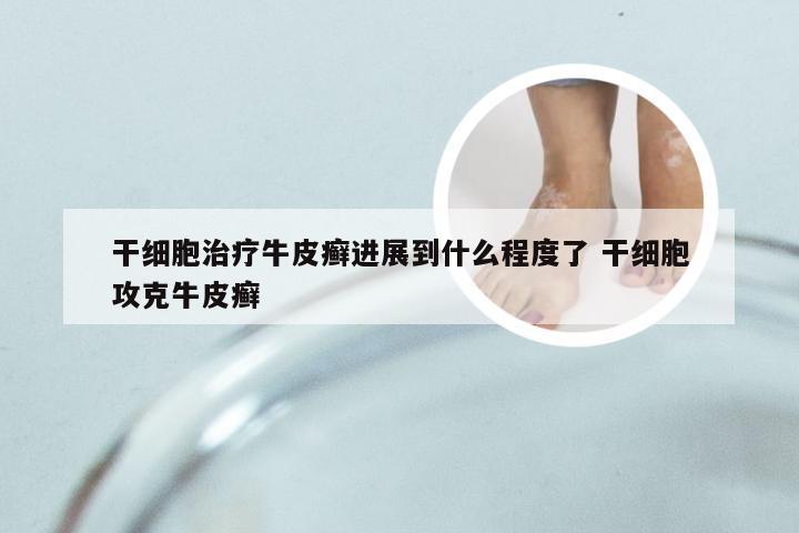 干细胞治疗牛皮癣进展到什么程度了 干细胞攻克牛皮癣