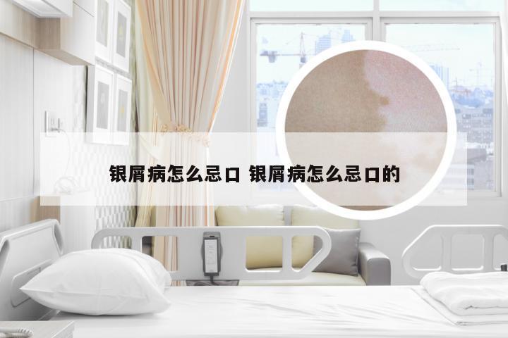 银屑病怎么忌口 银屑病怎么忌口的