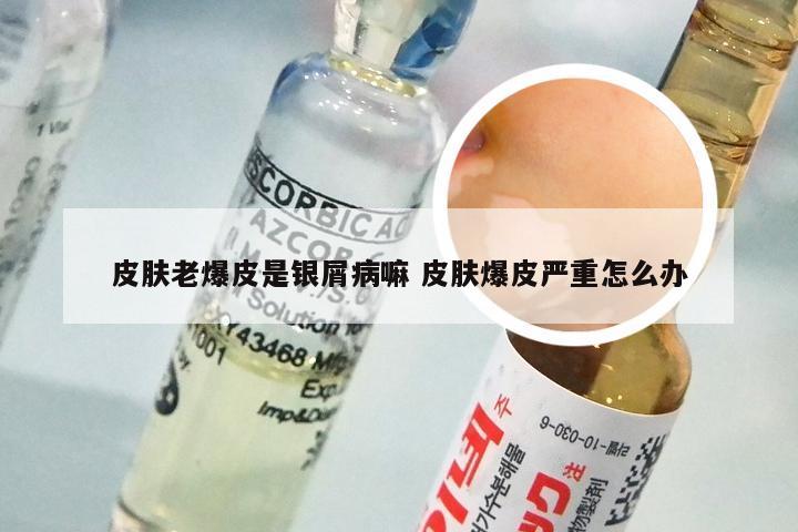 皮肤老爆皮是银屑病嘛 皮肤爆皮严重怎么办