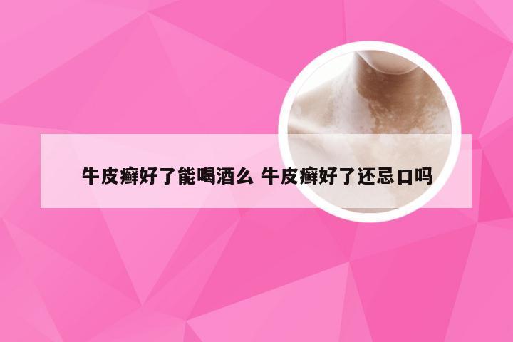 牛皮癣好了能喝酒么 牛皮癣好了还忌口吗