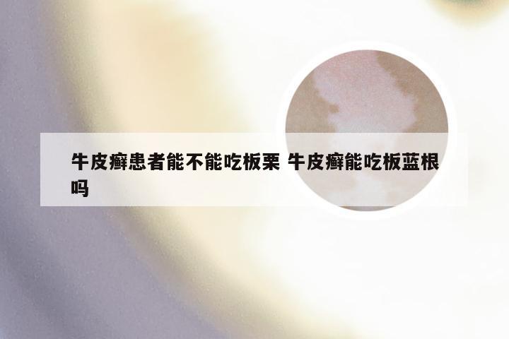 牛皮癣患者能不能吃板栗 牛皮癣能吃板蓝根吗