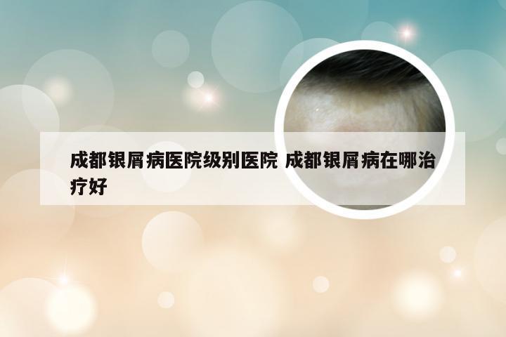 成都银屑病医院级别医院 成都银屑病在哪治疗好