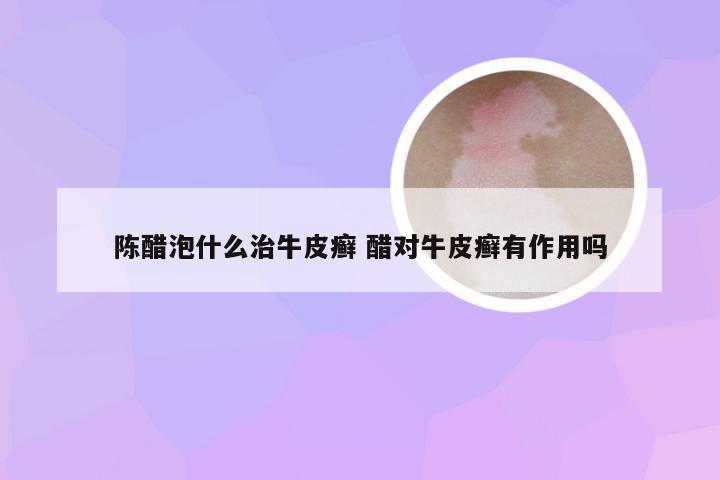 陈醋泡什么治牛皮癣 醋对牛皮癣有作用吗