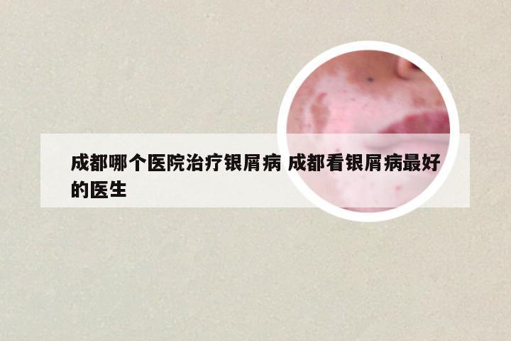成都哪个医院治疗银屑病 成都看银屑病最好的医生