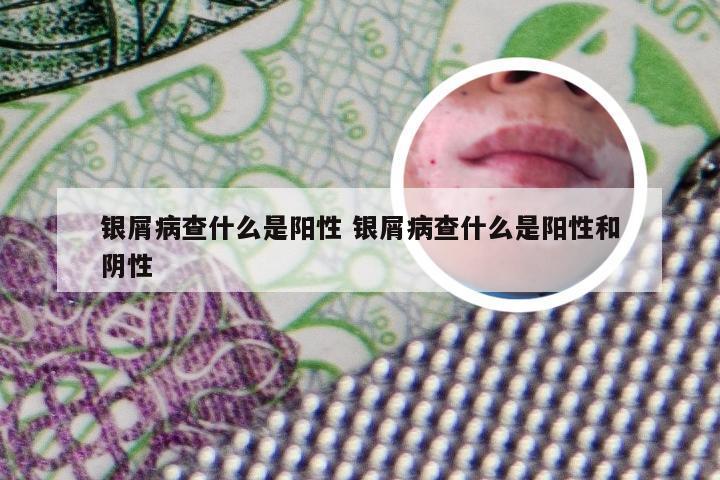 银屑病查什么是阳性 银屑病查什么是阳性和阴性