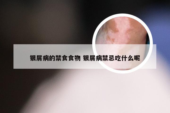 银屑病的禁食食物 银屑病禁忌吃什么呢
