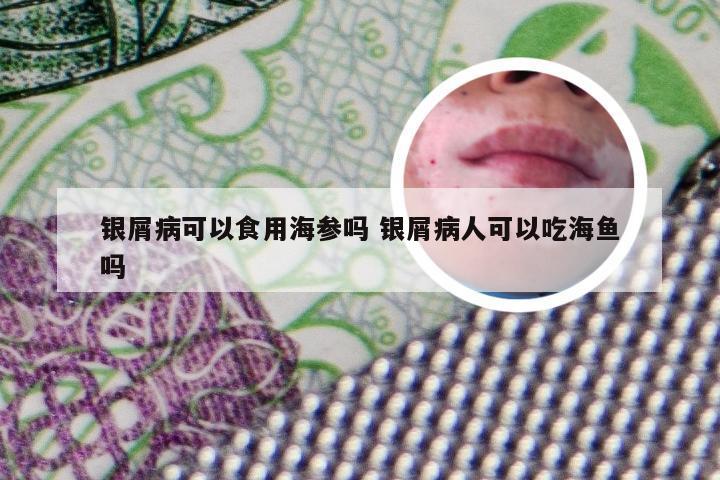 银屑病可以食用海参吗 银屑病人可以吃海鱼吗