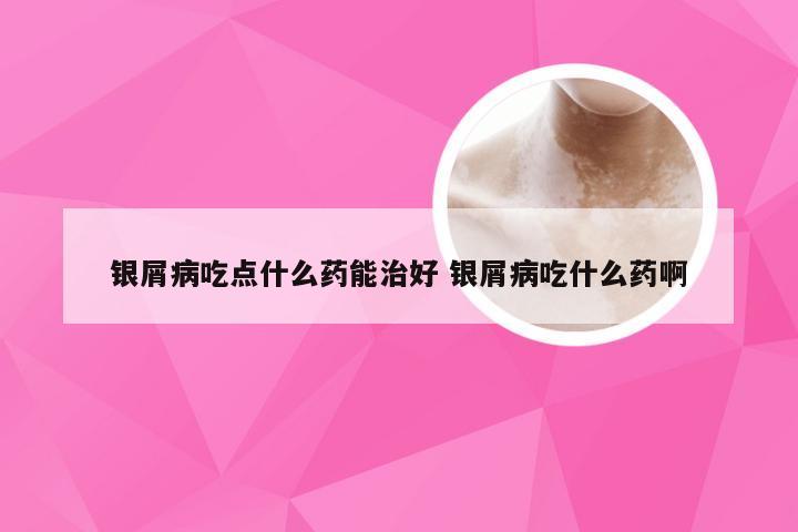 银屑病吃点什么药能治好 银屑病吃什么药啊