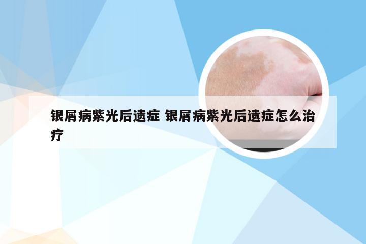 银屑病紫光后遗症 银屑病紫光后遗症怎么治疗