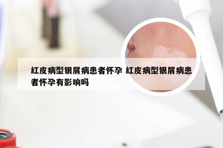 红皮病型银屑病患者怀孕 红皮病型银屑病患者怀孕有影响吗