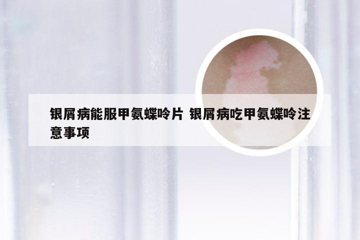 银屑病能服甲氨蝶呤片 银屑病吃甲氨蝶呤注意事项