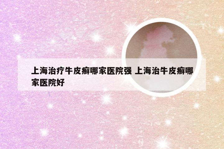 上海治疗牛皮癣哪家医院强 上海治牛皮癣哪家医院好