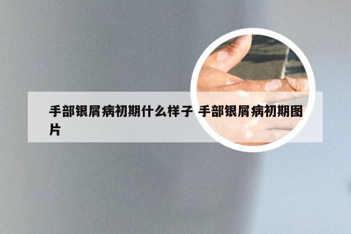 手部银屑病初期什么样子 手部银屑病初期图片