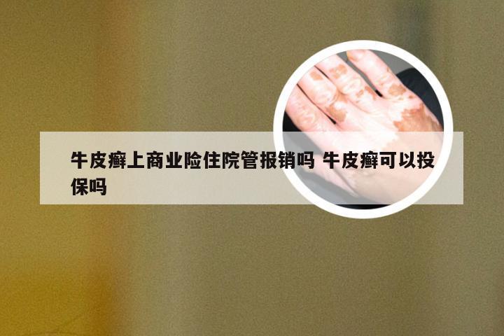 牛皮癣上商业险住院管报销吗 牛皮癣可以投保吗