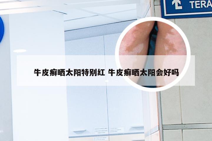 牛皮癣晒太阳特别红 牛皮癣晒太阳会好吗
