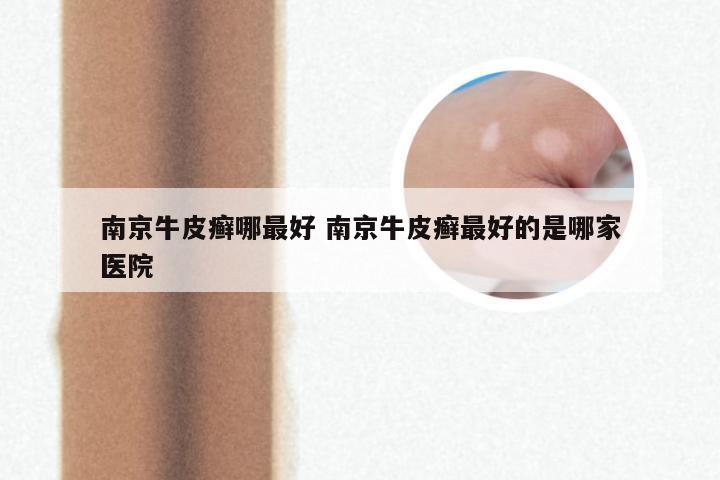 南京牛皮癣哪最好 南京牛皮癣最好的是哪家医院