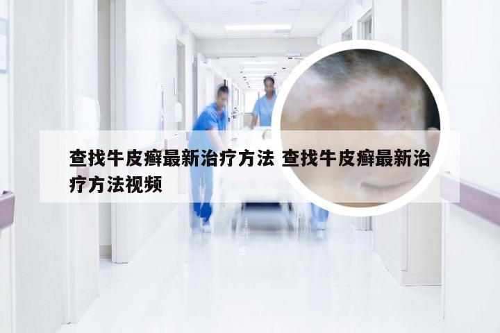 查找牛皮癣最新治疗方法 查找牛皮癣最新治疗方法视频