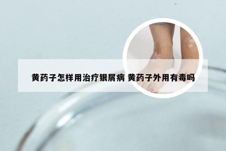 黄药子怎样用治疗银屑病 黄药子外用有毒吗