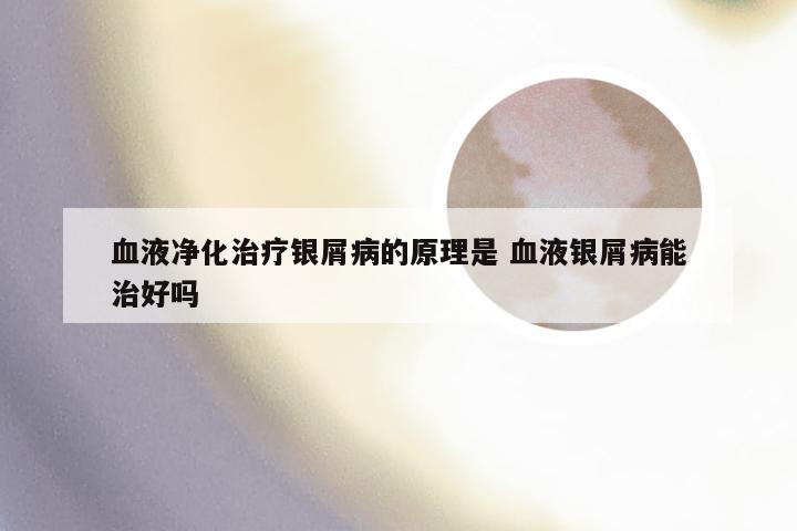 血液净化治疗银屑病的原理是 血液银屑病能治好吗