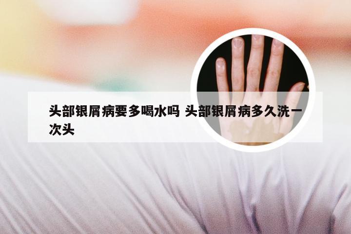 头部银屑病要多喝水吗 头部银屑病多久洗一次头