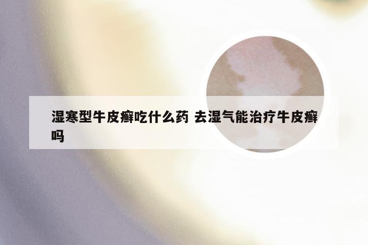 湿寒型牛皮癣吃什么药 去湿气能治疗牛皮癣吗