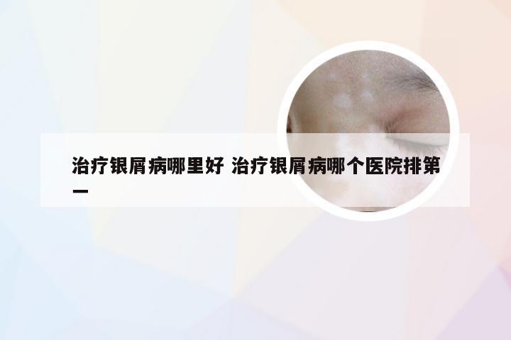 治疗银屑病哪里好 治疗银屑病哪个医院排第一