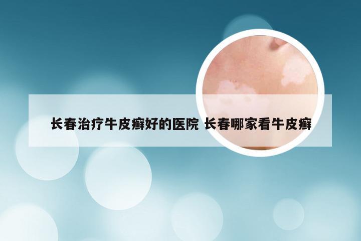 长春治疗牛皮癣好的医院 长春哪家看牛皮癣