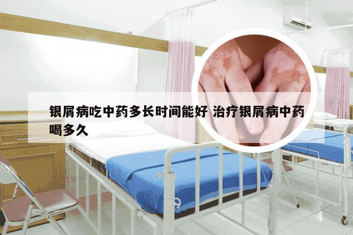 银屑病吃中药多长时间能好 治疗银屑病中药喝多久