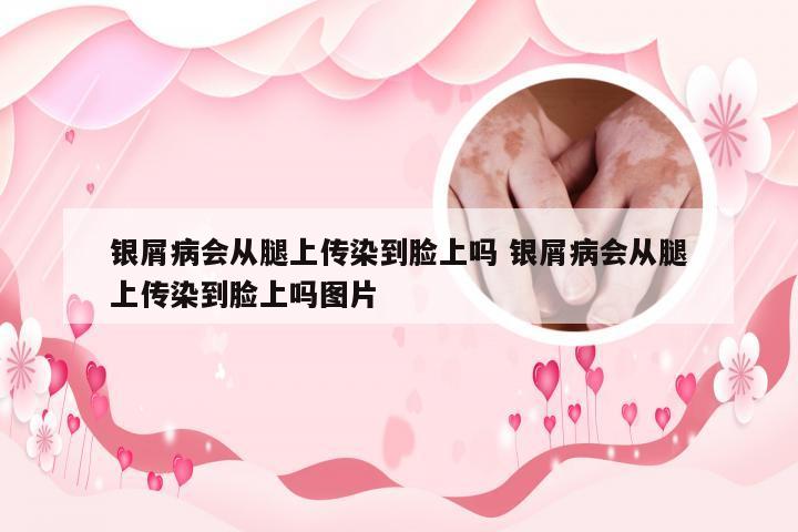 银屑病会从腿上传染到脸上吗 银屑病会从腿上传染到脸上吗图片