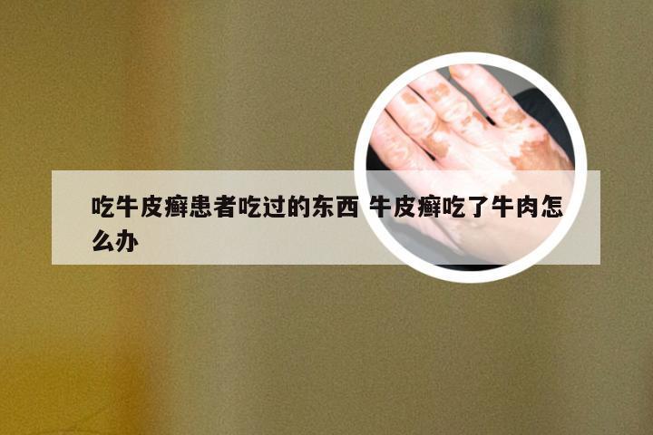 吃牛皮癣患者吃过的东西 牛皮癣吃了牛肉怎么办