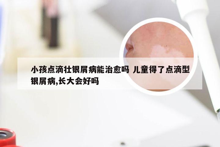 小孩点滴壮银屑病能治愈吗 儿童得了点滴型银屑病,长大会好吗