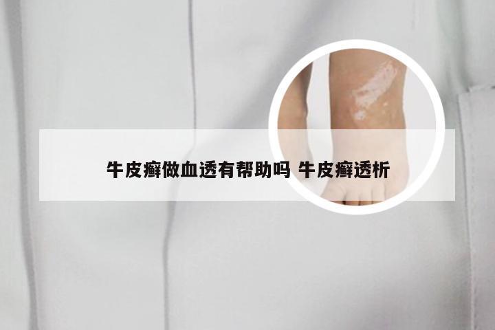 牛皮癣做血透有帮助吗 牛皮癣透析