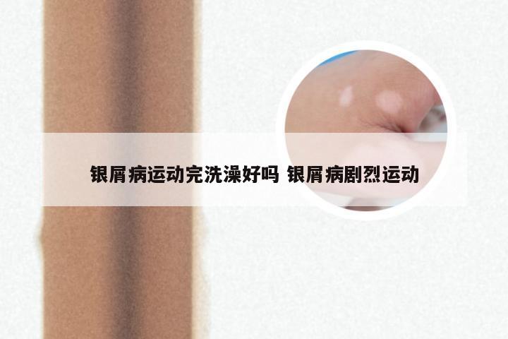 银屑病运动完洗澡好吗 银屑病剧烈运动