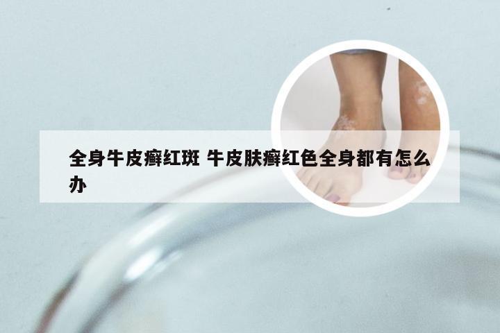 全身牛皮癣红斑 牛皮肤癣红色全身都有怎么办