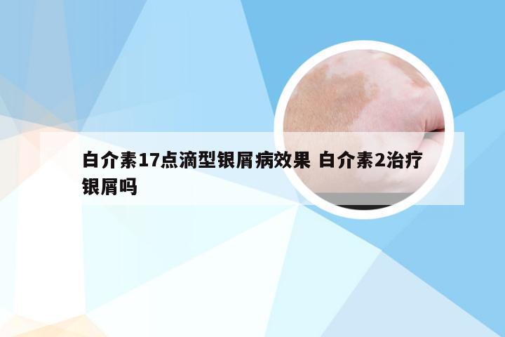 白介素17点滴型银屑病效果 白介素2治疗银屑吗