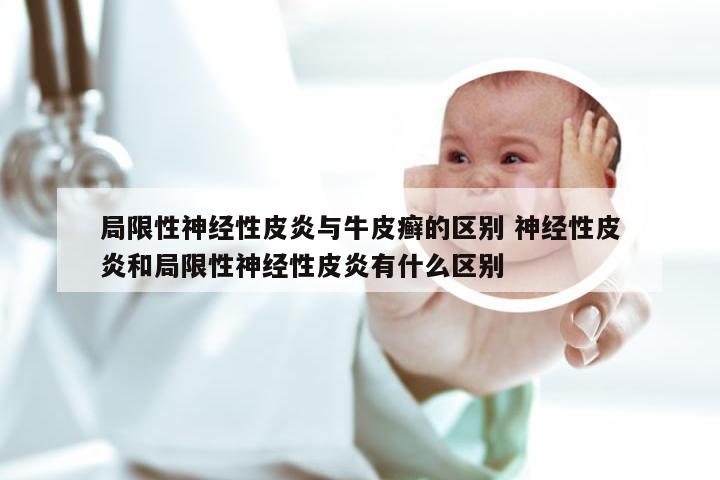 局限性神经性皮炎与牛皮癣的区别 神经性皮炎和局限性神经性皮炎有什么区别