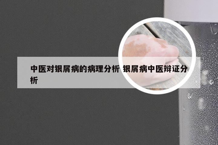 中医对银屑病的病理分析 银屑病中医辩证分析