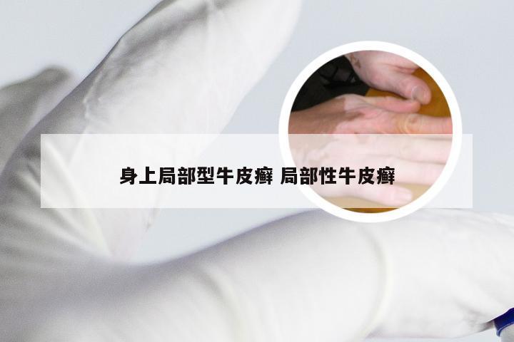 身上局部型牛皮癣 局部性牛皮癣