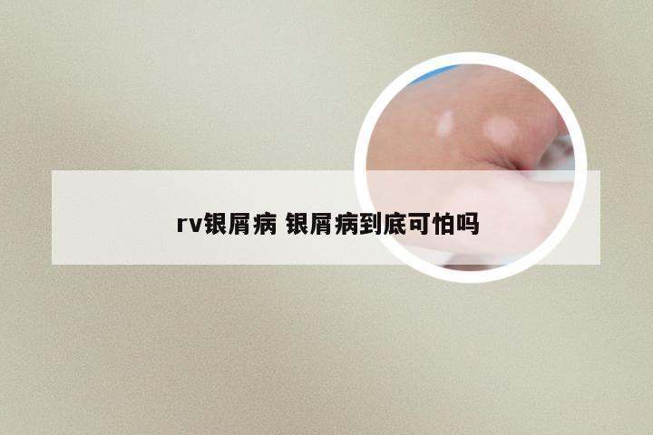 rv银屑病 银屑病到底可怕吗