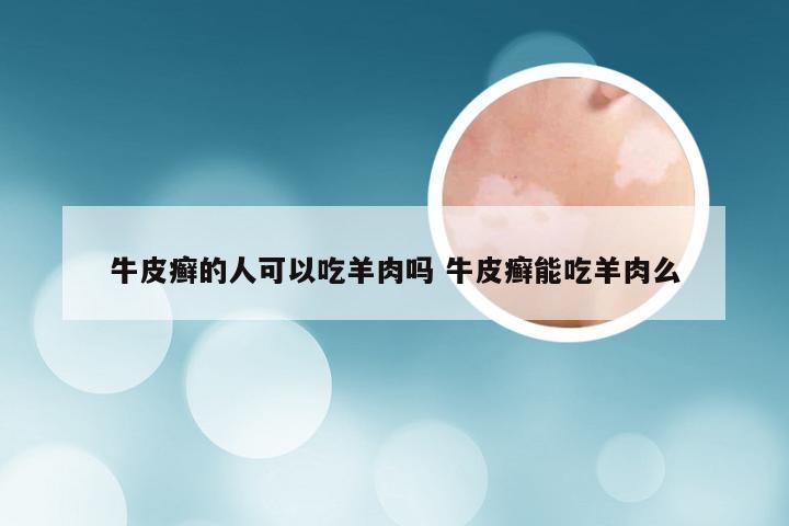 牛皮癣的人可以吃羊肉吗 牛皮癣能吃羊肉么