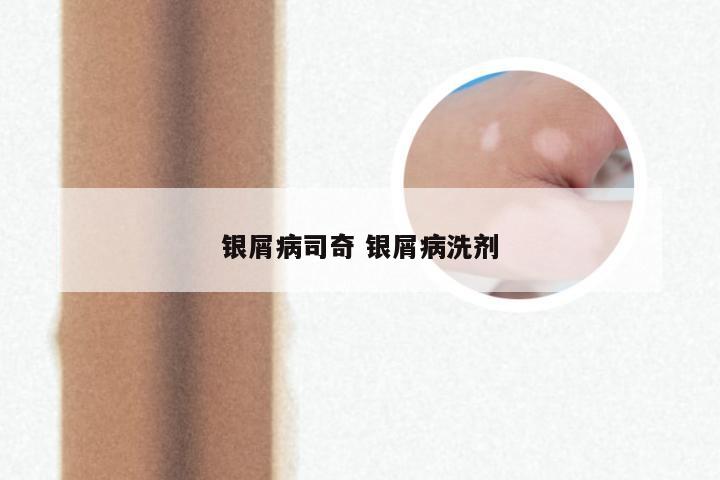 银屑病司奇 银屑病洗剂
