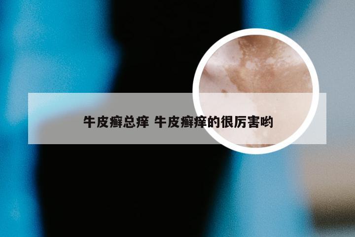 牛皮癣总痒 牛皮癣痒的很厉害哟