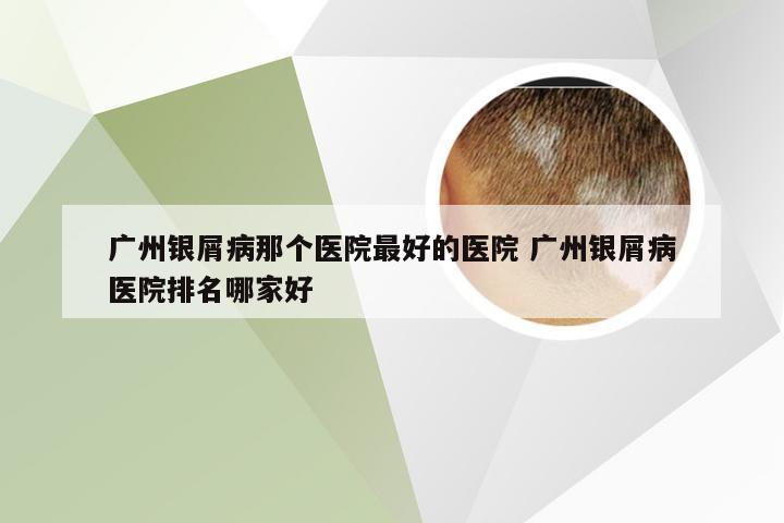广州银屑病那个医院最好的医院 广州银屑病医院排名哪家好