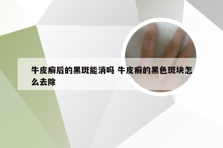 牛皮癣后的黑斑能消吗 牛皮癣的黑色斑块怎么去除