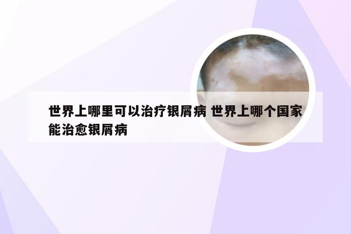世界上哪里可以治疗银屑病 世界上哪个国家能治愈银屑病