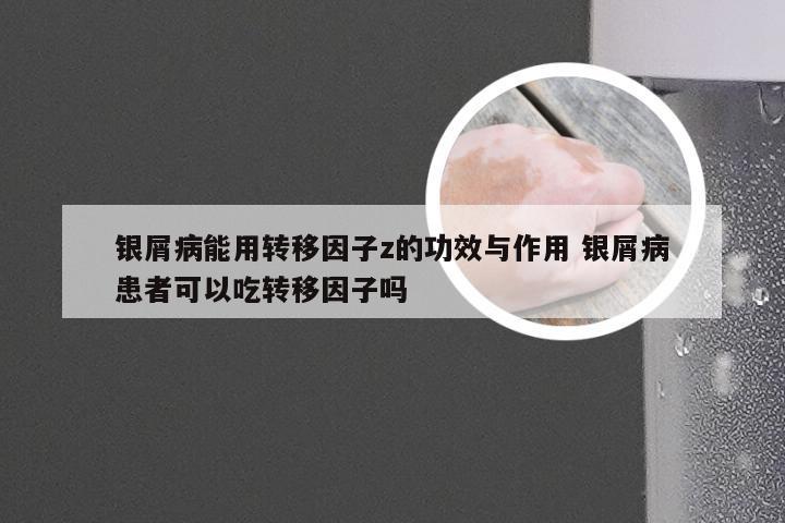 银屑病能用转移因子z的功效与作用 银屑病患者可以吃转移因子吗