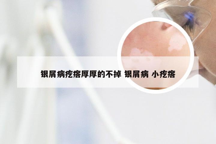 银屑病疙瘩厚厚的不掉 银屑病 小疙瘩