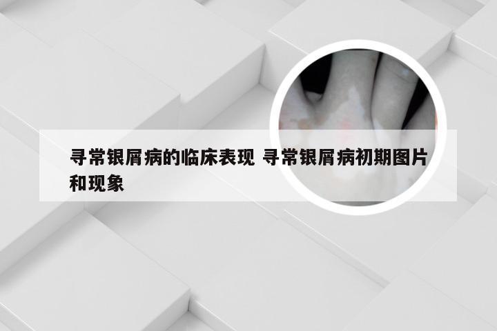 寻常银屑病的临床表现 寻常银屑病初期图片和现象